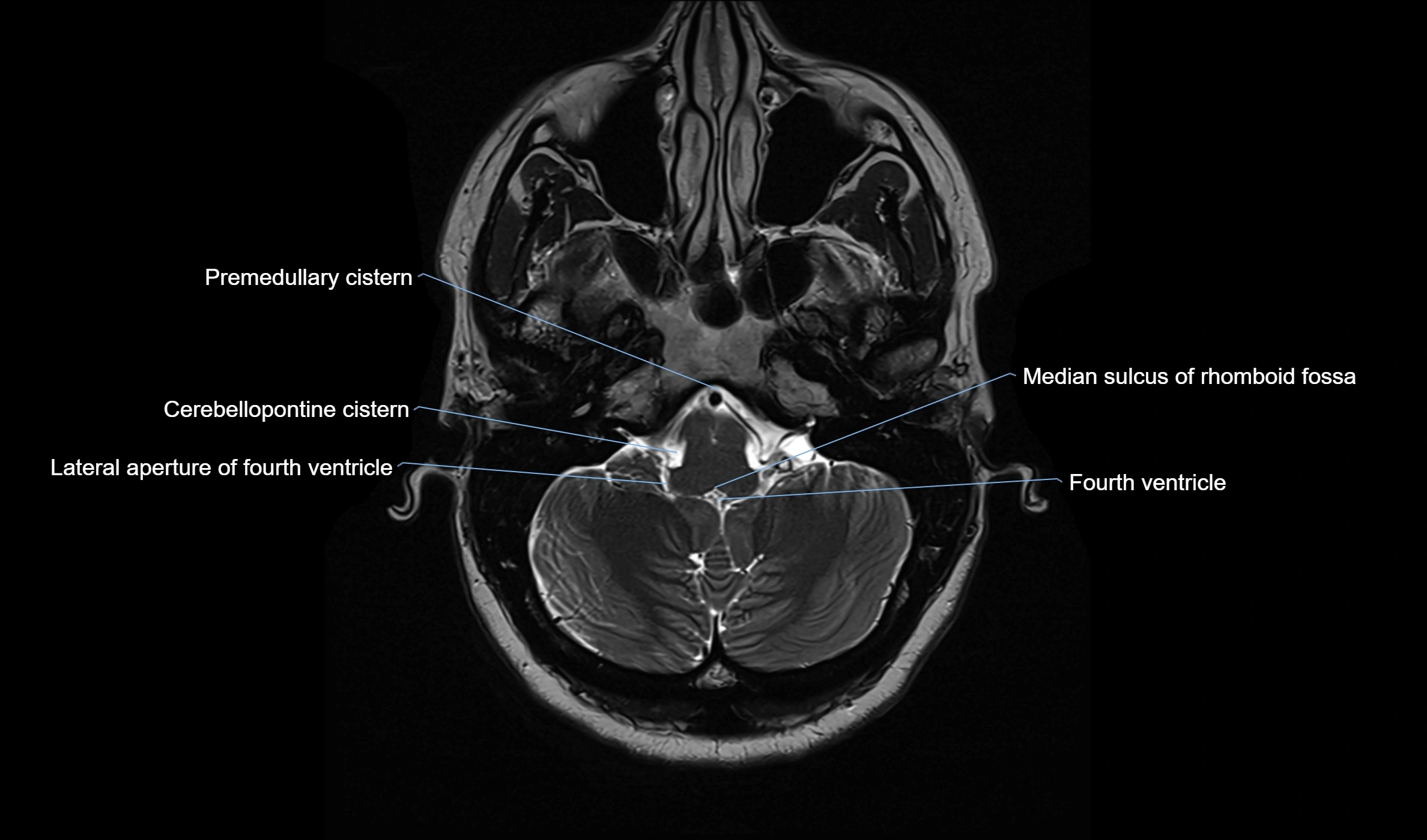 Brain cisterns  and ventricles  axial anatomy 3T MRI image-img-00001-00009.webp